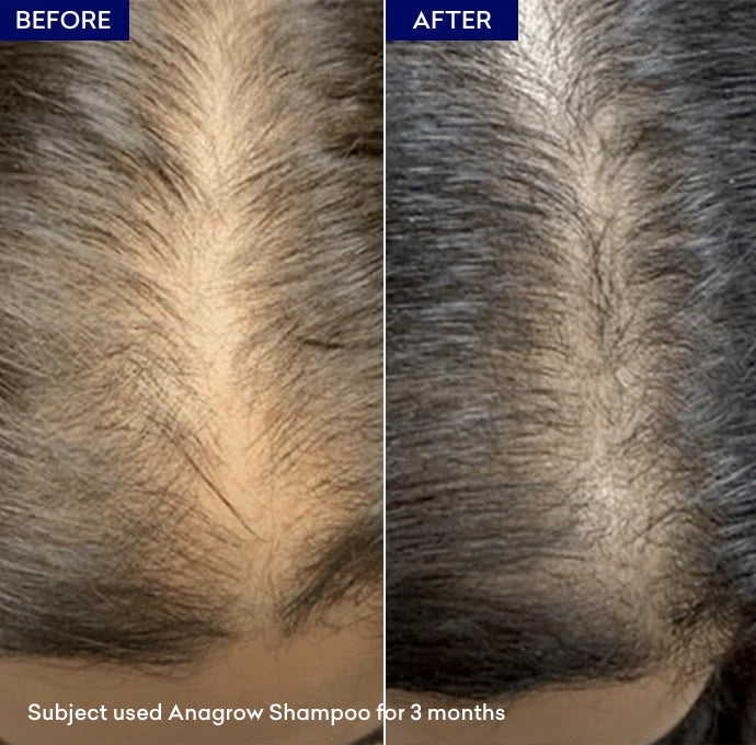 Anagrow Shampoo Reduces Hair Fall | Promotes Hair Growth