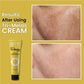 Melasma Tri Melas Cream – The Effective Solution for Melasma, Hyperpigmentation, and Uneven Skin Tone